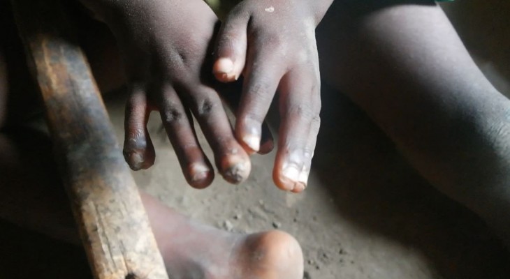 Jiggers Affecting Communities In Kanungu